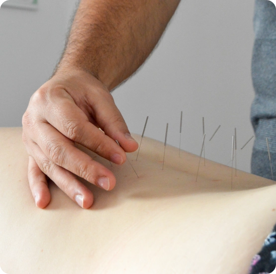 Dry Needling Therapy