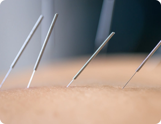 Schedule Your Dry Needling Therapy in Charleston, SC
